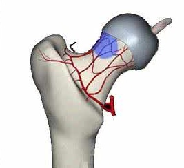 股骨头坏死的发生和哪些因素有关 引起股骨头坏死的原因