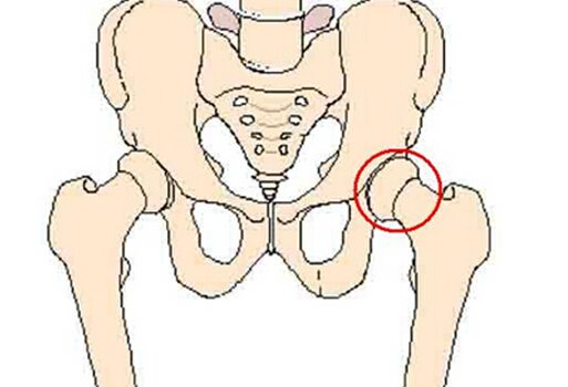 股骨头坏死的原因、症状以及治疗方法