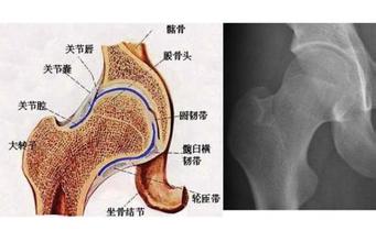 大家知道创伤性股骨头坏死的早期诊断吗