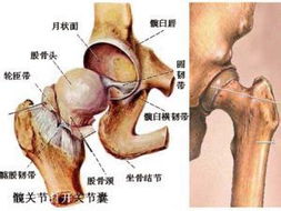 股骨头坏死的病因和早期表现