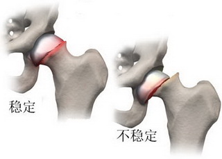 股骨头坏死的病因有哪些呢