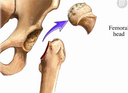 求助股骨头坏死疼痛怎么办啊