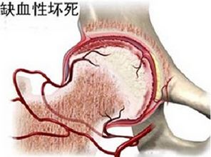 上海股骨头坏死医院西郊领先及上海治疗股骨头坏死医院