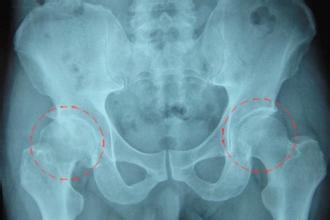 股骨头韧带损伤及圆韧带损伤的诊断及治疗